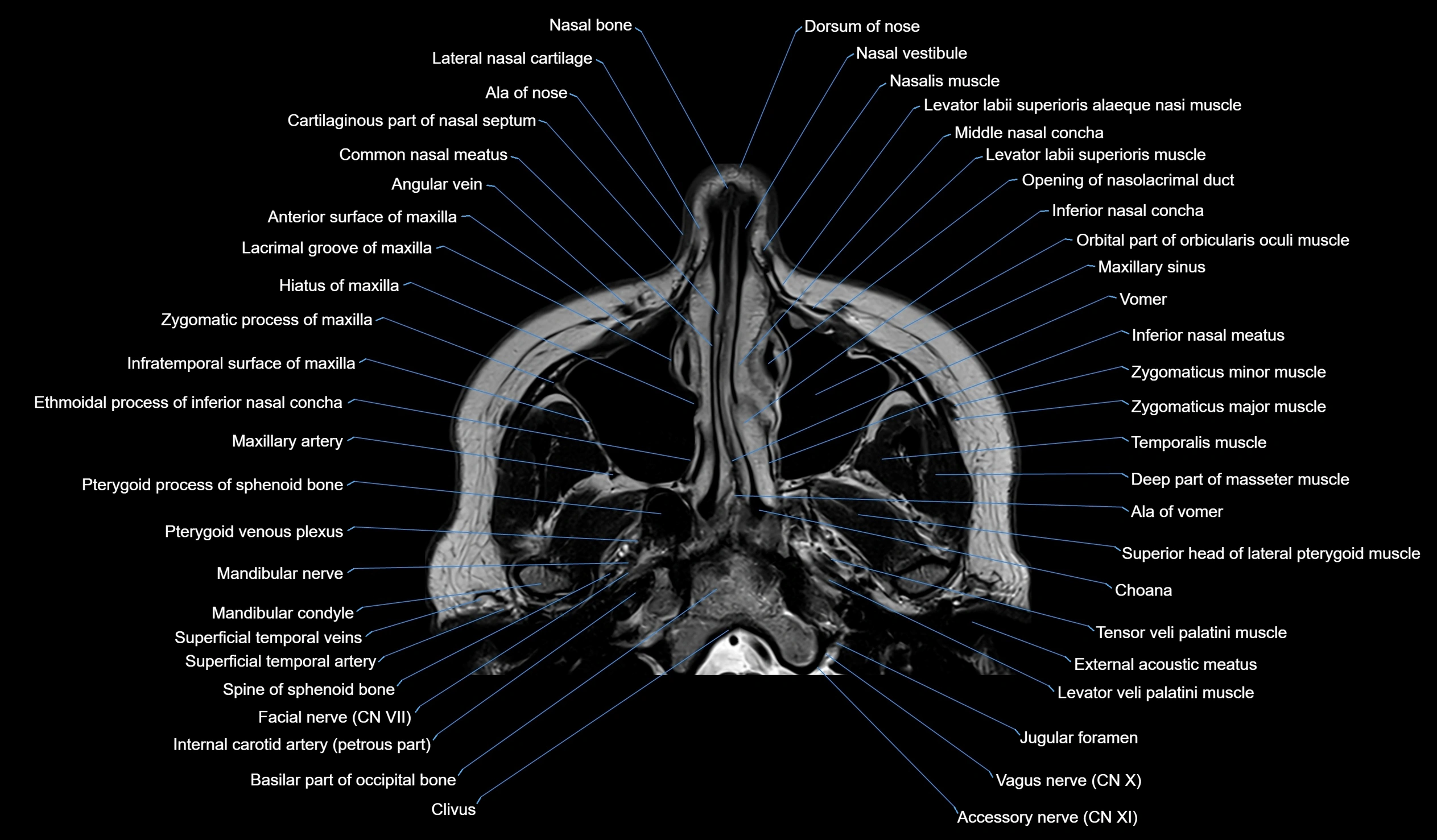 MRI face & paranasal sinuses(PNS) labelled  axial  cross sectional anatomy 3T radiology  image -00011.webp